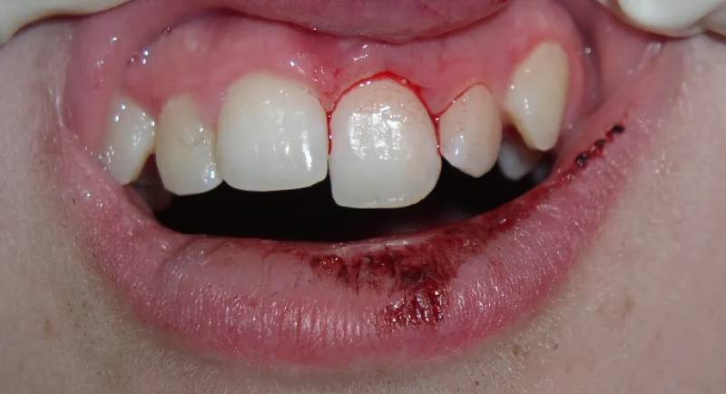 Mơ thấy gãy răng có chảy máu – tâm lý bất ổn, cần xốc lại tinh thần