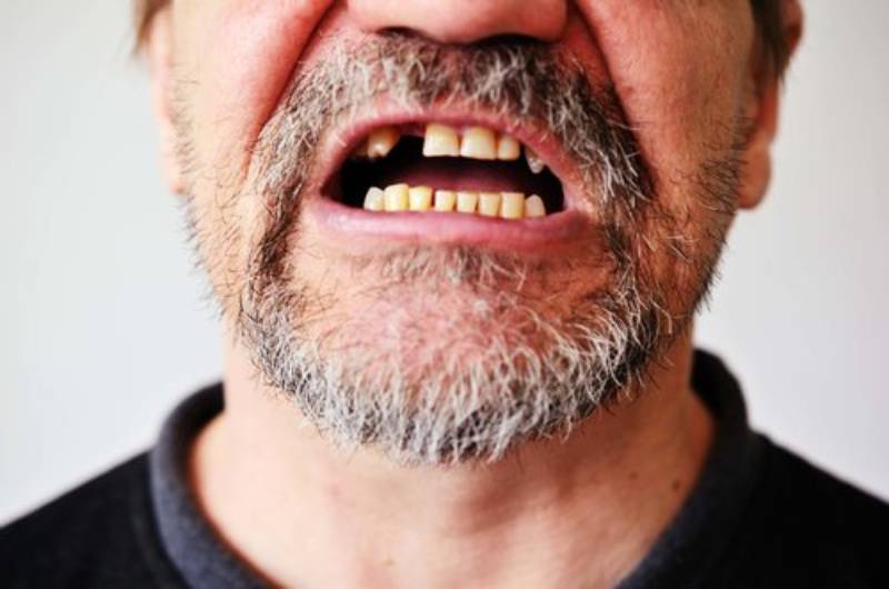 Mơ thấy người khác bị gãy răng – điềm cảnh báo về mối quan hệ xung quanh